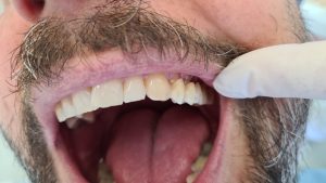Zubný mostík - nasádzanie